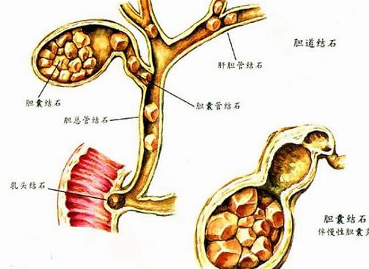 <em>胆囊结石怎样治疗</em>好_上海宏康医院结石科