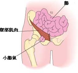 女性小肠<em>疝气</em>是<em>如何</em>引起的_上海宏康医院外科
