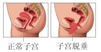 女性为什么会子宫脱垂_上海宏康医院妇科中心