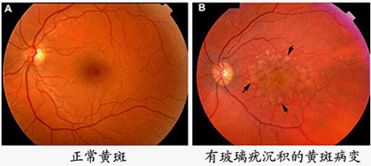 脉络膜血管侵入视网膜下构成脉络膜新生血管,发生黄斑区视网膜色素上